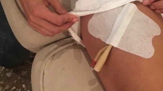 Kare Patch tubing support worn during activity
